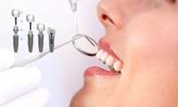 The Lifespan of Korean Dental Implants