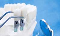 What is the Best Swiss Dental Implant Brand?