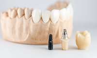 Opinions on Korean Dental Implants