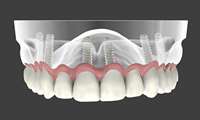 Can Dental Implants Fail?    