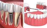 Differences Between Dental Implants and Dentures