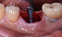 Immediate Implant: What Is It?