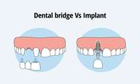 Difference Between Dental Implant and Bridge