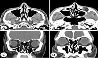 Comprehensive Article on Deviated Septum Surgery 