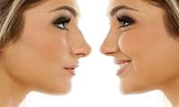 Comprehensive Article on Hump Nose Removal Surgery 