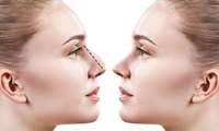 Comprehensive Article on Laser Nose Surgery