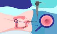 Colonoscopy and Its Importance in Diagnosing Gastrointestinal Diseases at Firouzabadi Hospital