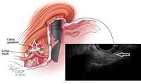 Endosonography for Stomach and Intestines: Accurate Diagnosis and Effective Treatment at Firouzabadi Hospital