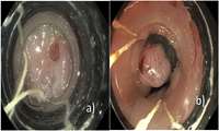 Endoscopic Band Ligation: An Effective Treatment for Gastrointestinal Disorders at Firouzabadi Hospital