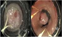 Endoscopic Band Ligation: An Effective Treatment for Gastrointestinal Disorders at Firouzabadi Hospital